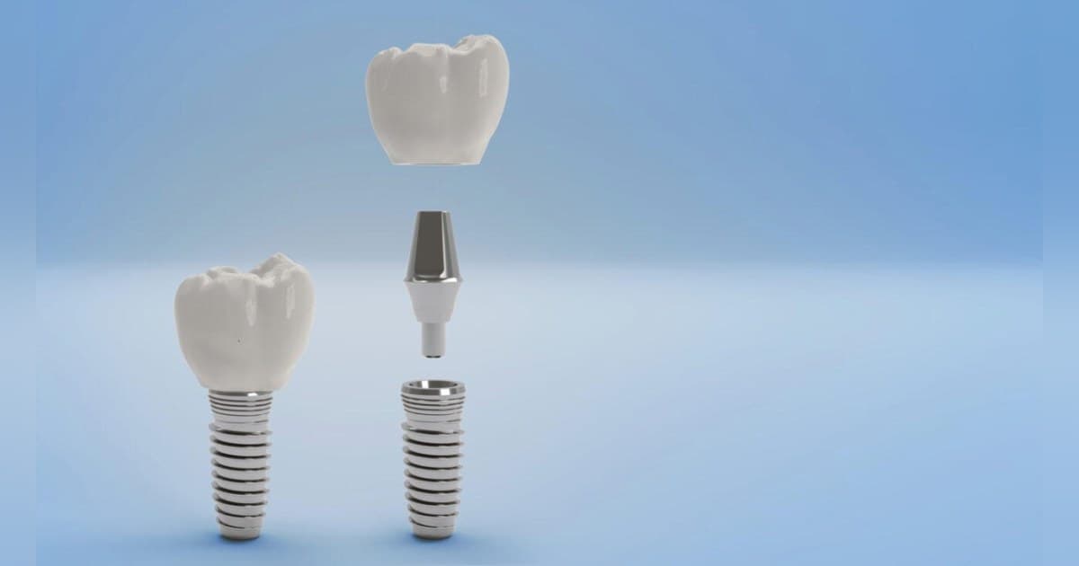 Gunbarrel Dental Center veröffentlicht klinische Leitlinie zu professionellen Zahnaufhellungsoptionen