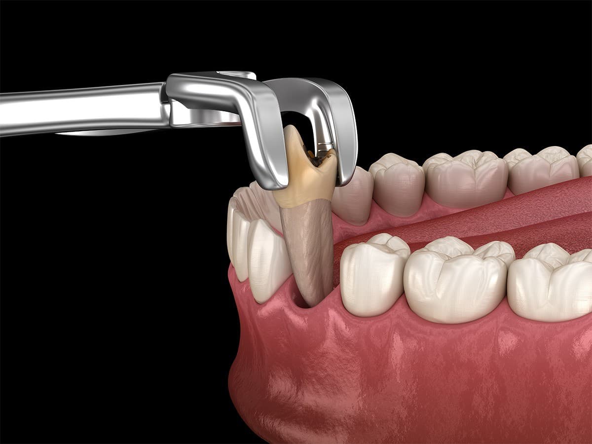 Praxis für Oralchirurgie in Sioux Falls veröffentlicht Leitfaden zur Verringerung von Ängsten vor Zahnextraktionen
