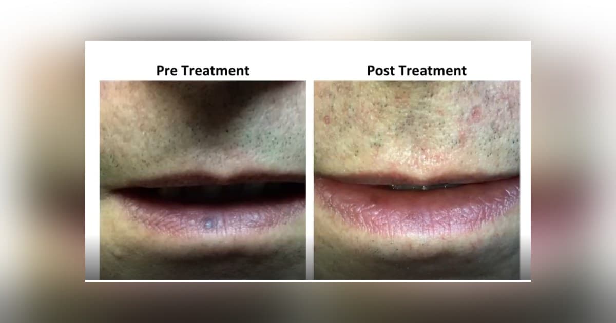 Gefäßchirurg aus Clifton bietet Laserbehandlung für venöse Seen an, eine häufige, aber wenig bekannte Lippenläsion