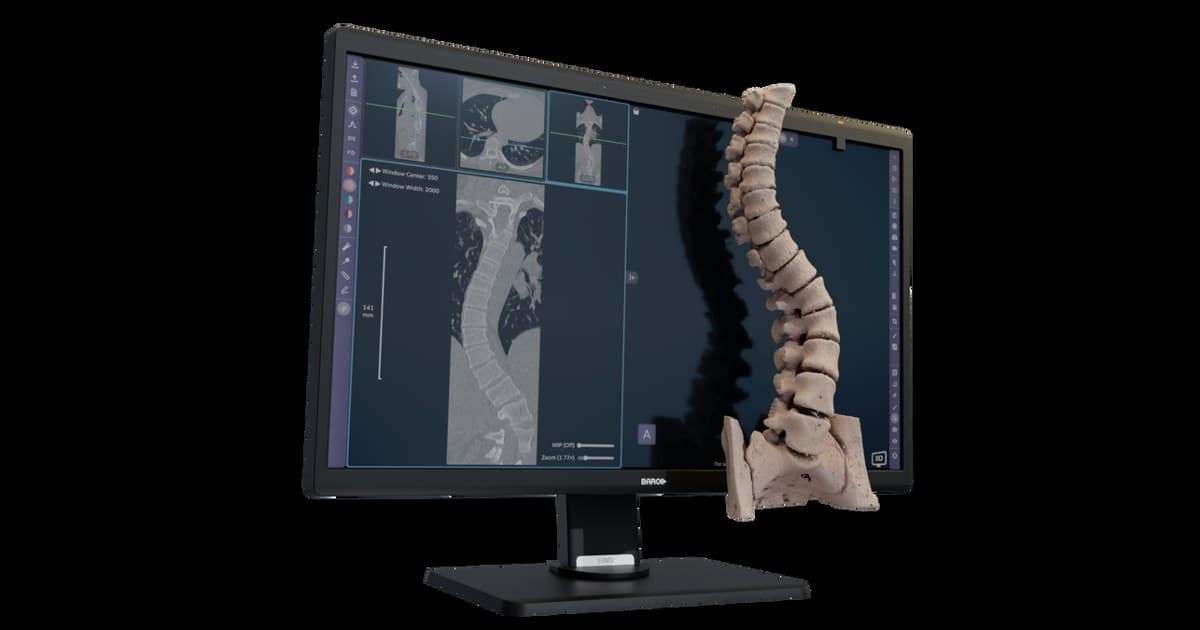 Avatar Medical Vision erhält CE-Kennzeichnung für brillenlose 3D-Chirurgieplanung